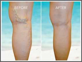 Before and after image of venefit procedure.
