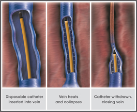 How the Venefit procedure works.